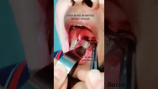 Fish bone removal from tonsil