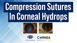 Partial Thickness compression suture for Acute hydrops | Cornea Colours | Season-2 | Ep-2