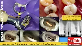 one visit root canal treatment one curve micro mega endodontic xtrabase voco passive ultrasonic