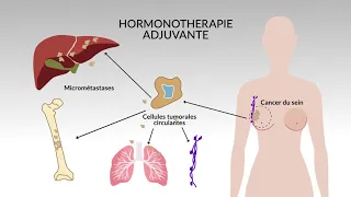 Pr. GILLES FREYER = Hormonothérapie du cancer du sein