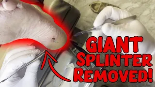 Splinter Removal: Watch as We Extract a Massive Splinter from a Patient's Heel!