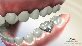 Orthodontic Band Placement on a Molar