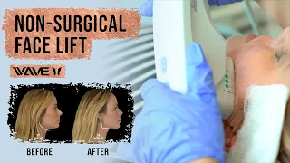 3 Ways To Get A Facelift Without Surgery | FAST and EASY Solution!