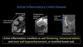 Crohn Disease: Part 1   Active Inflammation