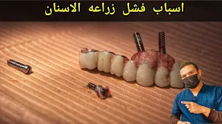 4 اسباب لفشل زراعه الاسنان |نصائح لنجاح زراعه الاسنان