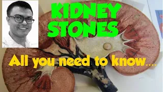 KIDNEY STONES...ALL YOU NEED TO KNOW!!