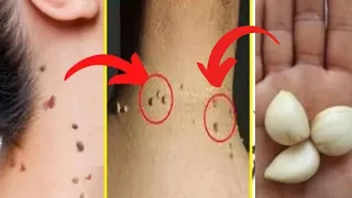 Remove skin tags in one day.  Get rid of skin tags quickly and easily