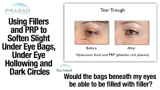 Slight Under Eye Bags Can be Treated with Cosmetic Fillers