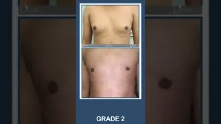 Best Results Gynecomastia 2 | Gynecomastia Grade 2