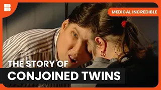 Living as a Conjoined Twin - Medical Incredible - Documentary