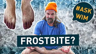 How to deal with frostbite? | #AskWim