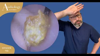 DIFFICULT & PAINSTAKING EAR WAX REMOVAL - EP735