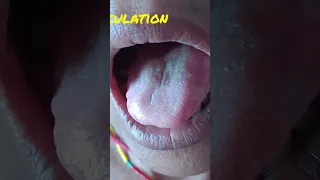 tongue fasciculation