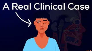 What is Bell's Palsy? Causes, Symptoms, Pathophysiology, & Treatments