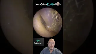 Teenage ear wax - #ear #earwax #earwaxremoval #earcleaning #asmr #asmrearwax #satisfying