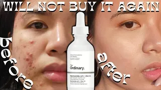 6 MONTHS OF THE ORDINARY NIACINAMIDE | I will stop 🛑 using it on my acne skin *not a clickbait* !!