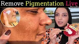 How I Removed Pigmentation of My Maid's Face? See Live Results by Memoona Muslima