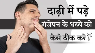 दाढ़ी में पड़े गंजेपन के धब्बे को कैसे ठीक करे | Alopecia Areata Beard | Alopecia Areata Treatment