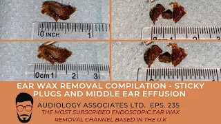 EAR WAX REMOVAL COMPILATION - STICKY PLUGS AND MIDDLE EAR EFFUSION - EP 235