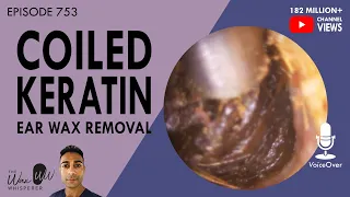 753 - Coiled Keratin Ear Wax Removal