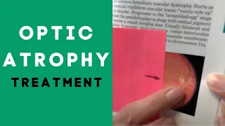 What Is Optic Atrophy?