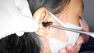 this COCKROACH was living in her EAR..