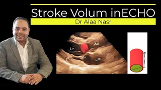 Stroke Volum and VTI calculation in ECHO, Dr Alaa Nasr, 2023