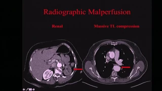 Emory Cardiology Grand Rounds 04-17-2017