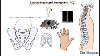 Анкилозирующий спондилит (болезнь Бехтерева) | определение, этиология, патогенез, клиника, диаг, леч