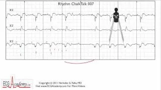 ECG Interpretation Tutorial - ChalkTalk 07 - Advanced Level