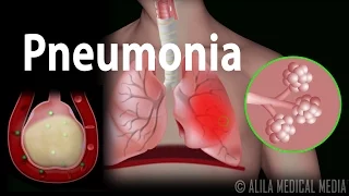 Pneumonia, Animation