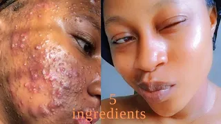 How to Remove Stubborn pimples|Dark spots|Acne|Fast!!! 5 ingredients| Get a Glass skin#clear#acne