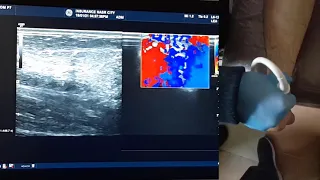 How-To-Perform Achilles Tendon Ultrasound (Case Demonstration)