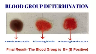 Blood Group Test = Procedure for Determination of Blood Group | Blood Group Determination Test