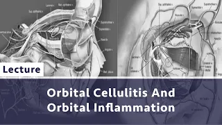 Orbital Cellulitis And Orbital Inflammation