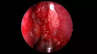 Light Probe-Assisted Endoscopic DCR