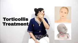 Torticollis Physiotherapy Exercises and Stretches | Torticollis Treatment in hindi |