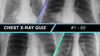 Chest X-ray Quiz #1 - 50