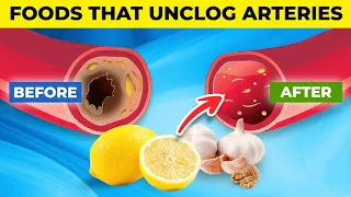 10 AMAZING Foods that UNCLOG Arteries...