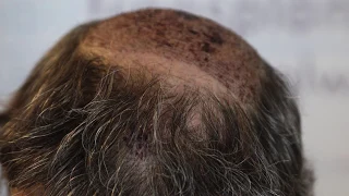 Haartransplantation Türkei - Erfahrungen nach 6 Monaten - Elithairtransplant Istanbul