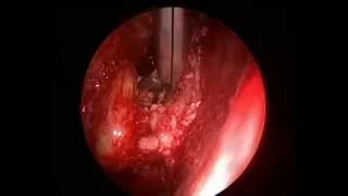 Ossifying fibroma- Orbital apex- combined approach ( Short video) - Dr.Satish Jain & Dr.Pankaj Gupta