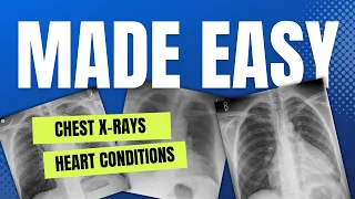 Heart Conditions: Chest X-rays Made Easy