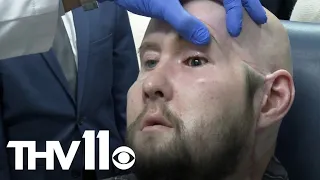 Arkansas man receives first eye transplant and a new face with hopes of restoring sight