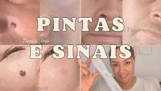 Pintas e sinais no rosto como retirar / Jato de Plasma para pintas/ Porque temos pintas?