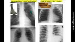 شرح أشعة القلب Heart x-Rays د. محمود سويلم