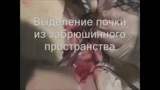 Павел Пульняшенко: симультанная операция: поликистоз, гистеровариоэктомия
