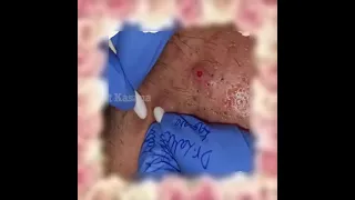 BEST Pimple Popping | Big Cystic Acne Blackheads | Squeezing Pimples  | VL#103