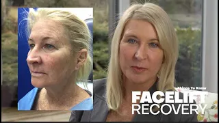 My Facelift Recovery - What To Expect - Things To Know - Pain? Timeline?