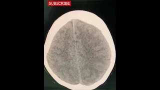 Diffuse Cerebral edema - CT Brain -Radiology