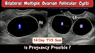 TVS Ultrasound - Bilateral multiple Ovarian Follicular Cysts